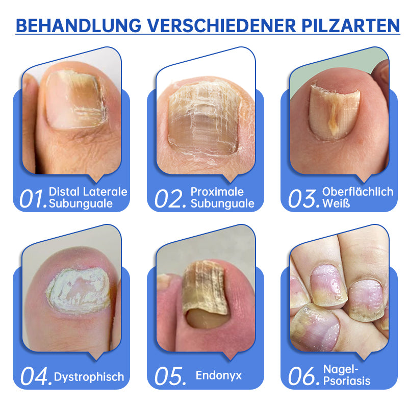 PureNail | Pilz-Lasertherapiegerät - Ihre Geheimwaffe gegen Nagelpilz